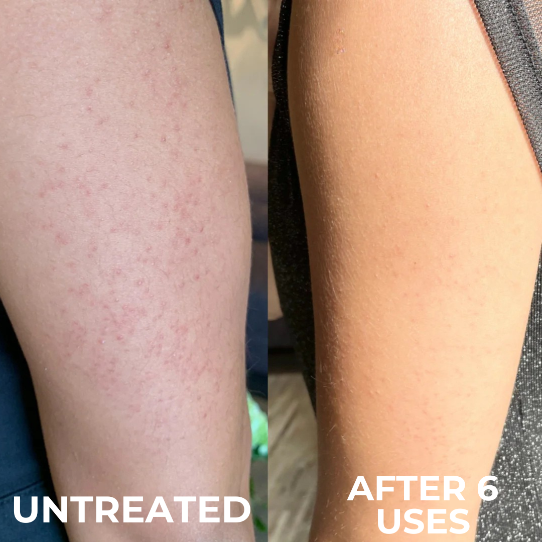 Everkind Advanced Strawberry Resurfacing Complex