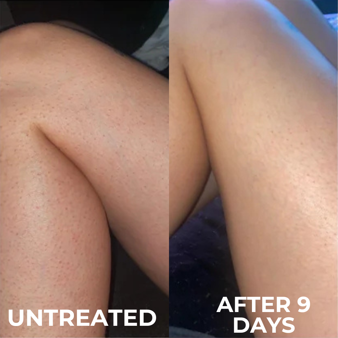 Everkind Advanced Strawberry Resurfacing Complex